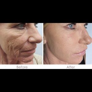 2 micro needling pens and tips